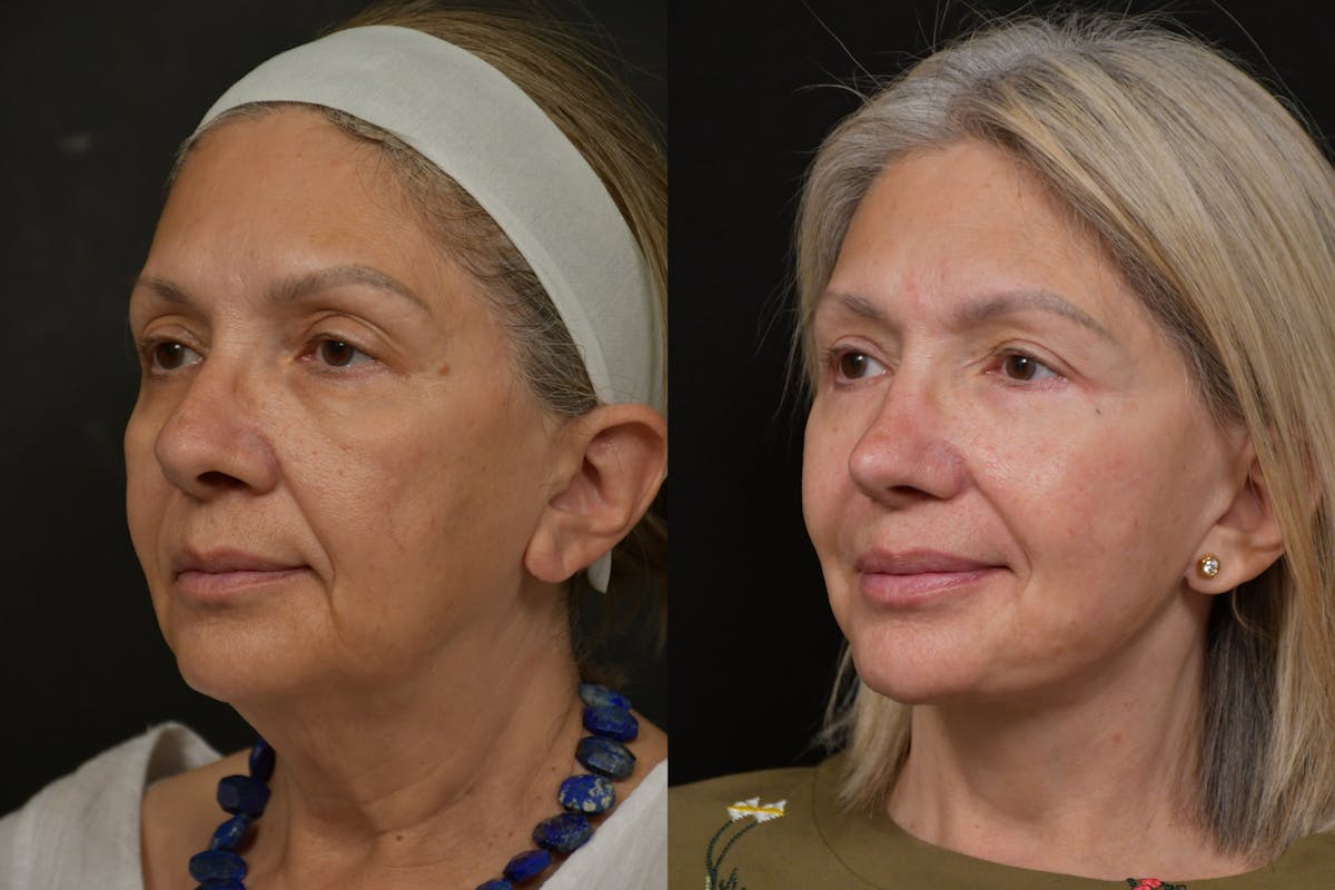 Changes Rapid Lift  Before & After Gallery - Patient 263705 - Image 1
