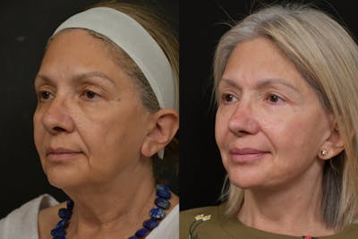 Changes Rapid Lift  Before & After Gallery - Patient 263705 - Image 1