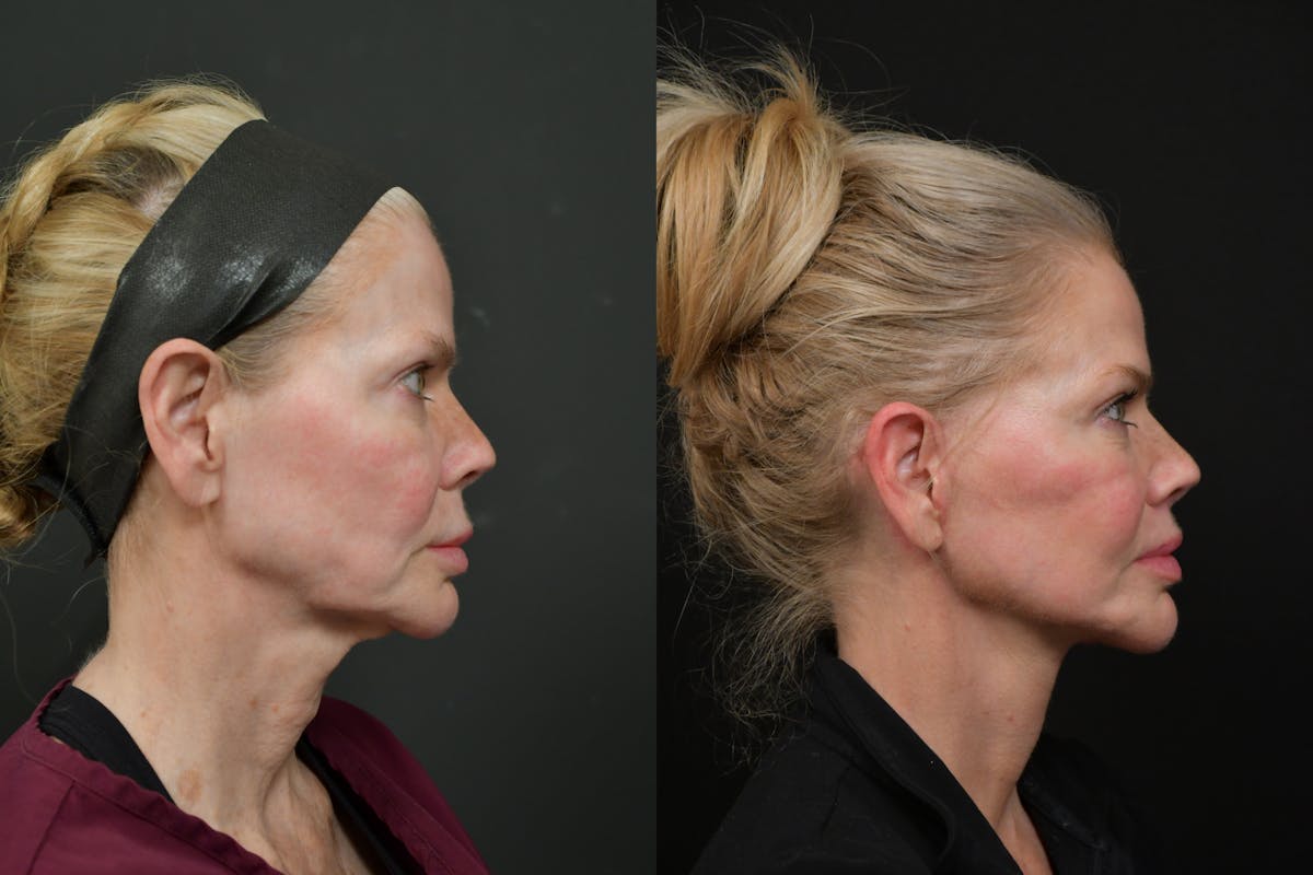 Changes Rapid Lift  Before & After Gallery - Patient 221423 - Image 4