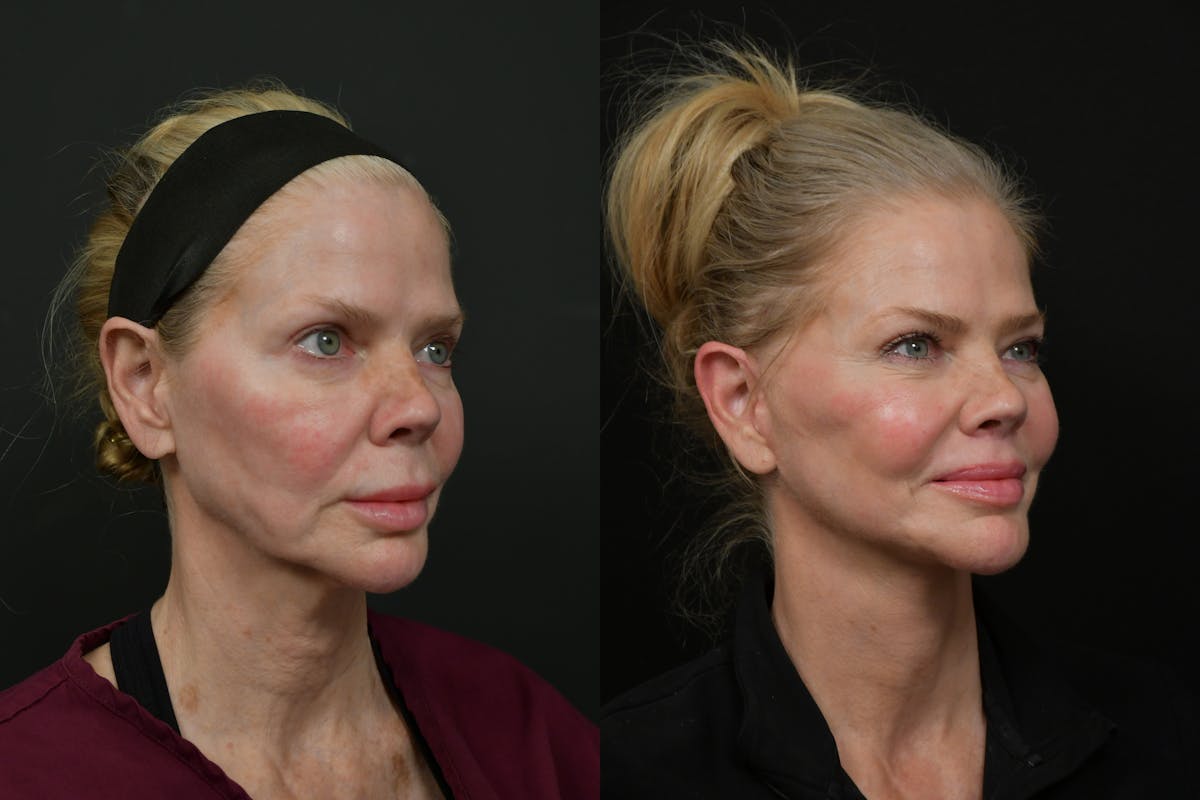 Changes Rapid Lift  Before & After Gallery - Patient 221423 - Image 3