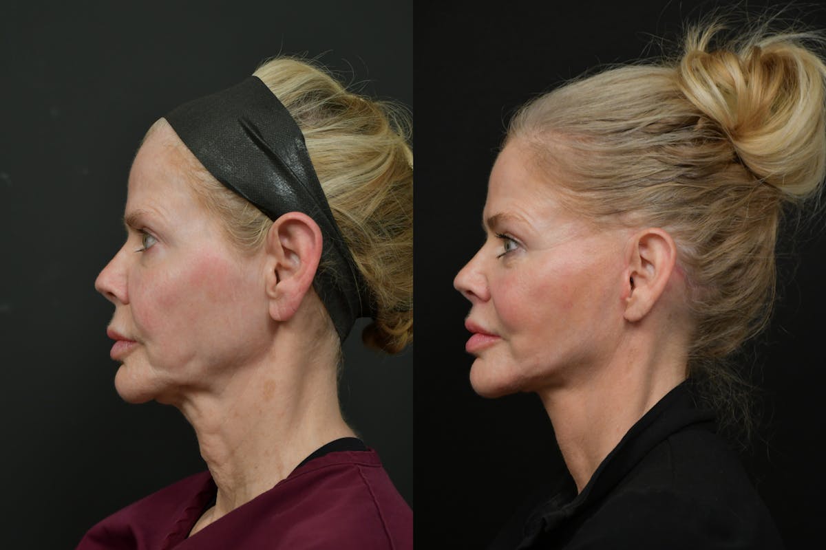 Changes Rapid Lift  Before & After Gallery - Patient 221423 - Image 2