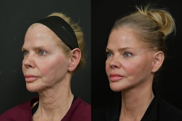 Changes Rapid Lift  Before & After Gallery - Patient 221423 - Image 1