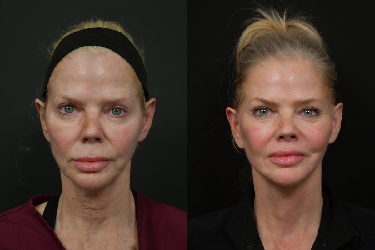Changes Rapid Lift  Before & After Gallery - Patient 221423 - Image 5