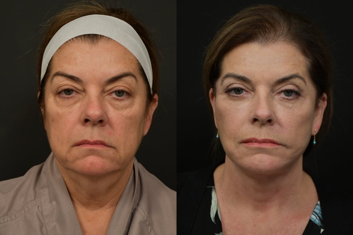 Eyelid Surgery Before & After Gallery - Patient 324279 - Image 1