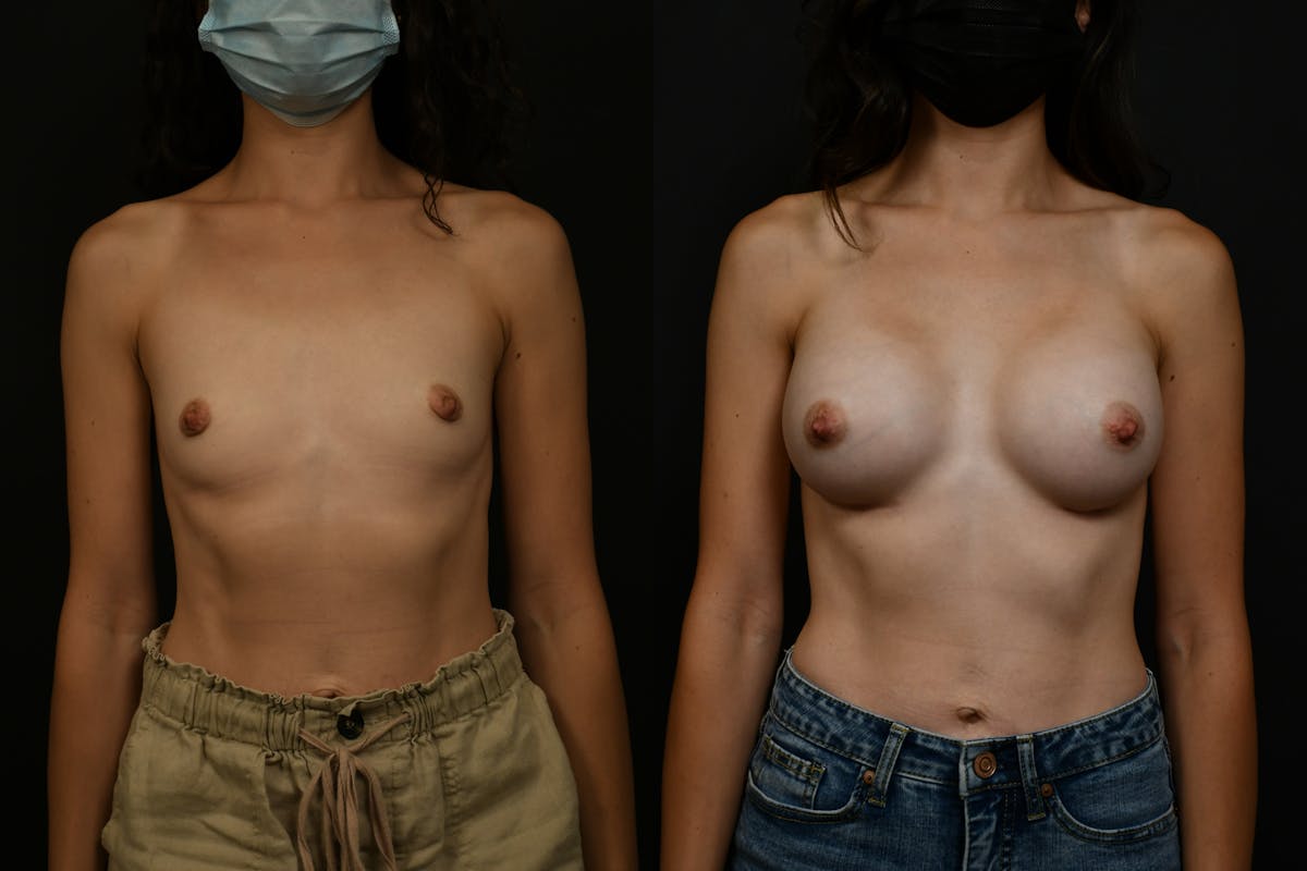 Breast Augmentation Before & After Gallery - Patient 709730 - Image 1