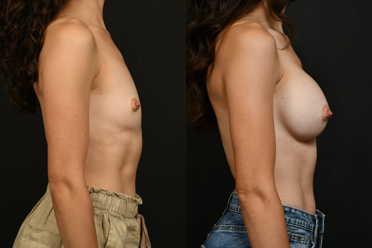 Breast Augmentation Before & After Gallery - Patient 709730 - Image 3