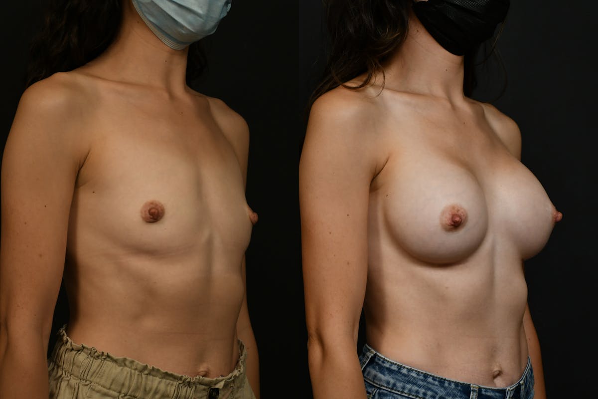 Breast Augmentation Before & After Gallery - Patient 709730 - Image 2