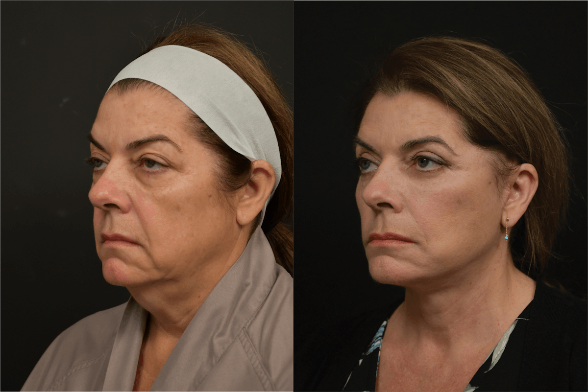 Eyelid Surgery Before & After Gallery - Patient 324279 - Image 2