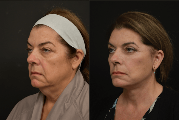 Changes Rapid Lift  Before & After Gallery - Patient 144948 - Image 1