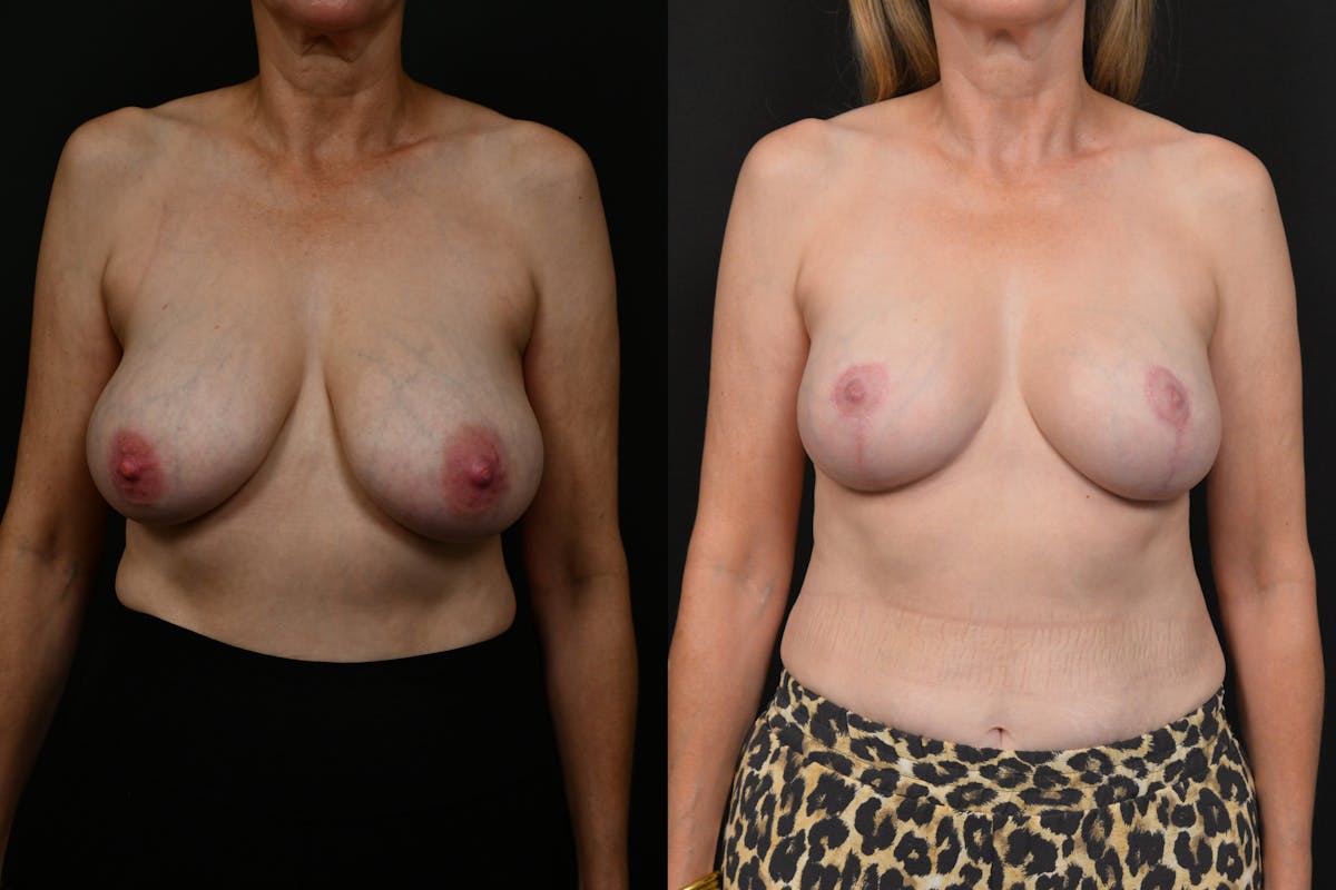 Breast Reduction Before & After Gallery - Patient 226401 - Image 1