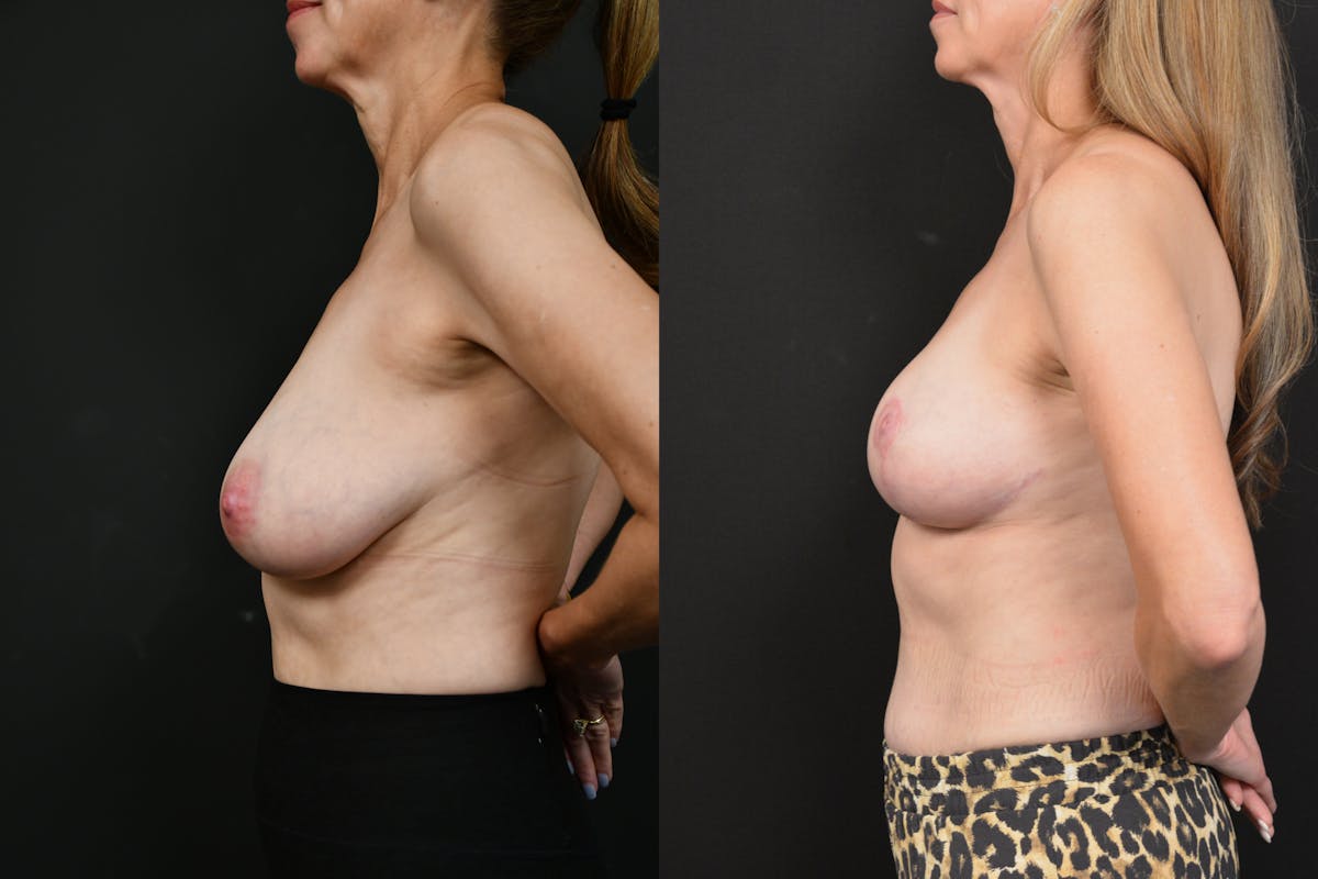 Breast Reduction Before & After Gallery - Patient 226401 - Image 5