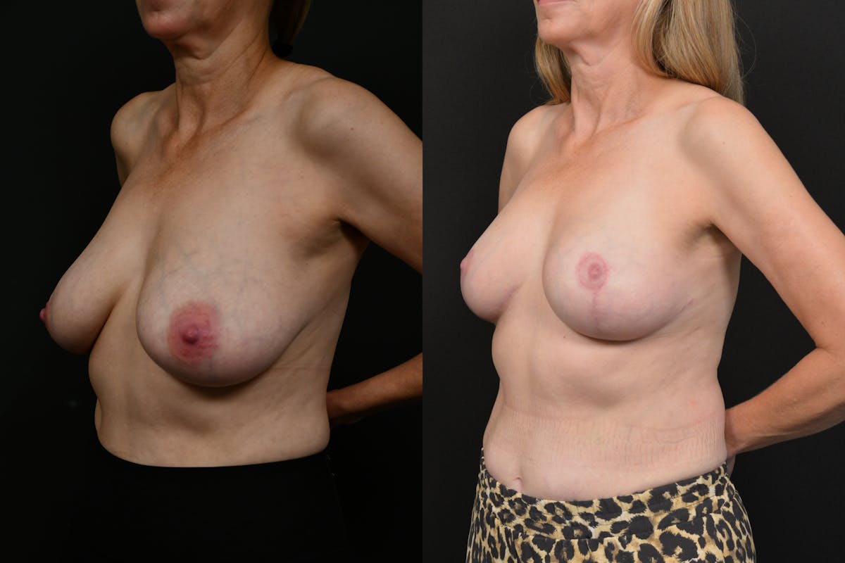 Breast Reduction Before & After Gallery - Patient 226401 - Image 4