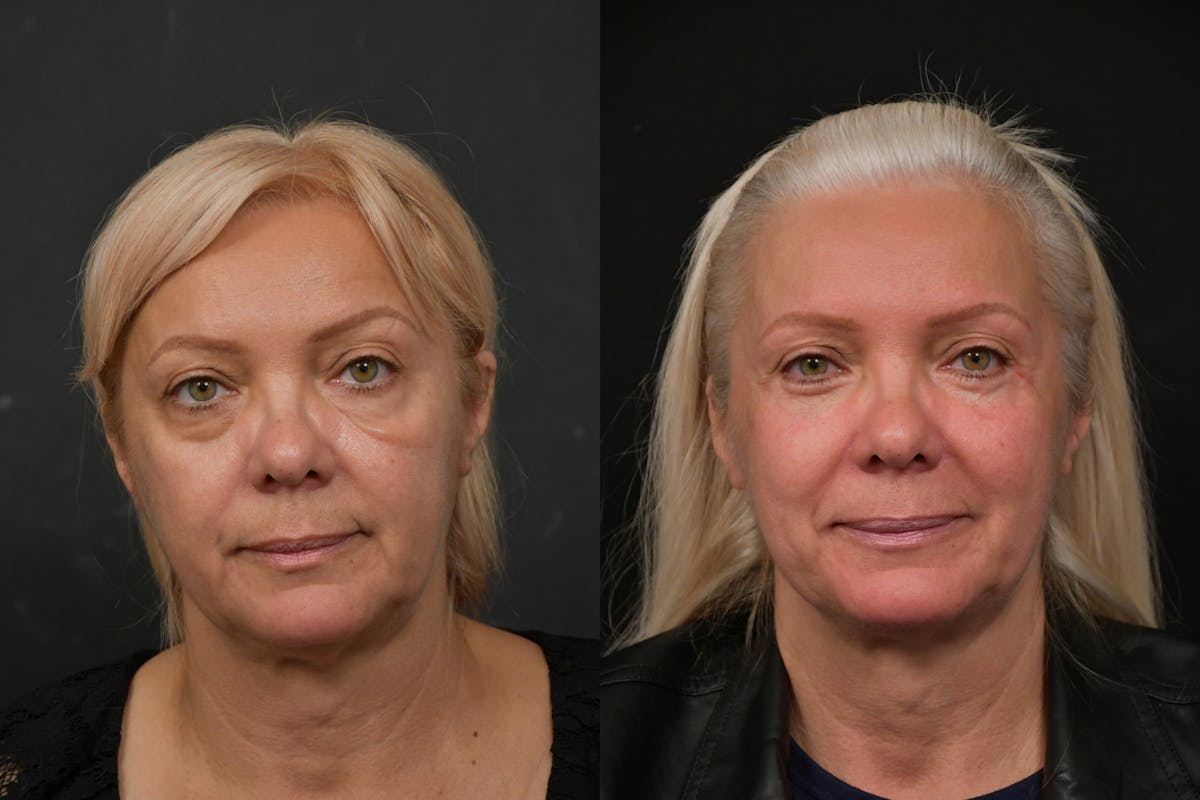 Eyelid Surgery Before & After Gallery - Patient 291221 - Image 1