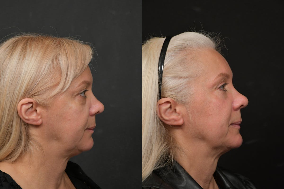 Eyelid Surgery Before & After Gallery - Patient 291221 - Image 5