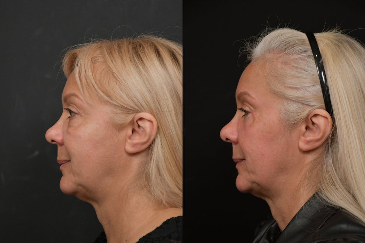 Eyelid Surgery Before & After Gallery - Patient 291221 - Image 3