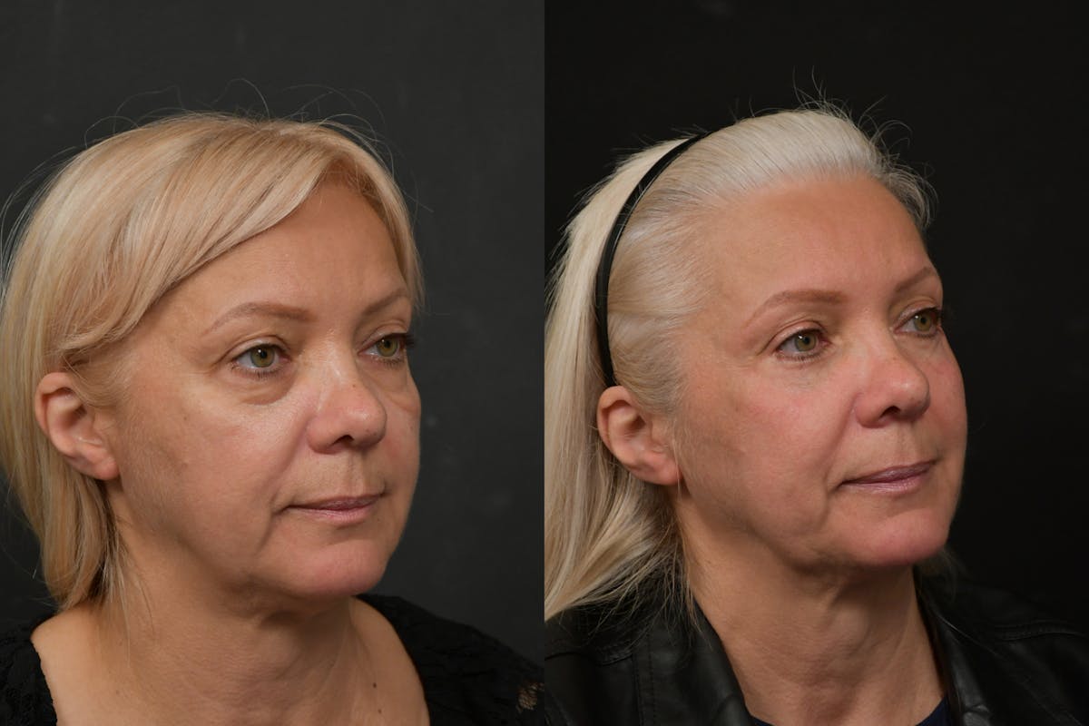Eyelid Surgery Before & After Gallery - Patient 291221 - Image 4