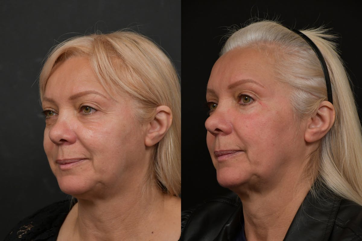 Eyelid Surgery Before & After Gallery - Patient 291221 - Image 2