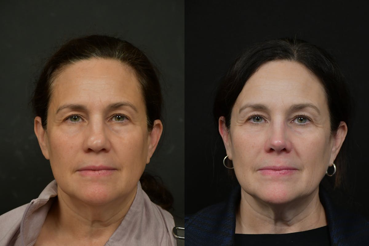 Rhinoplasty Before & After Gallery - Patient 273068 - Image 5