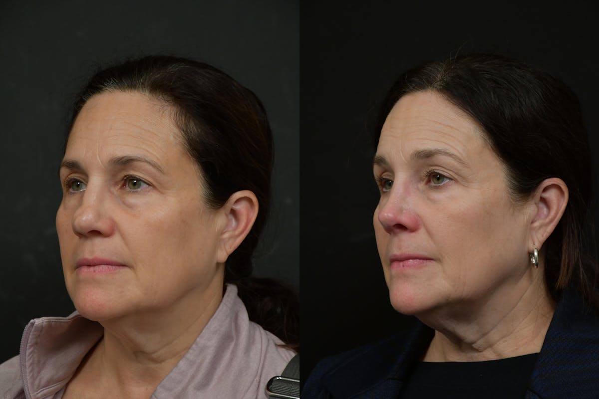 Rhinoplasty Before & After Gallery - Patient 273068 - Image 1