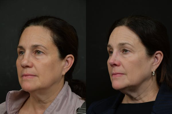 Rhinoplasty Before & After Gallery - Patient 273068 - Image 1