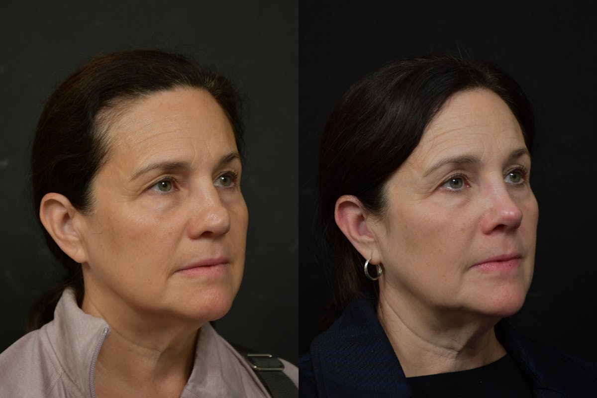 Rhinoplasty Before & After Gallery - Patient 273068 - Image 3