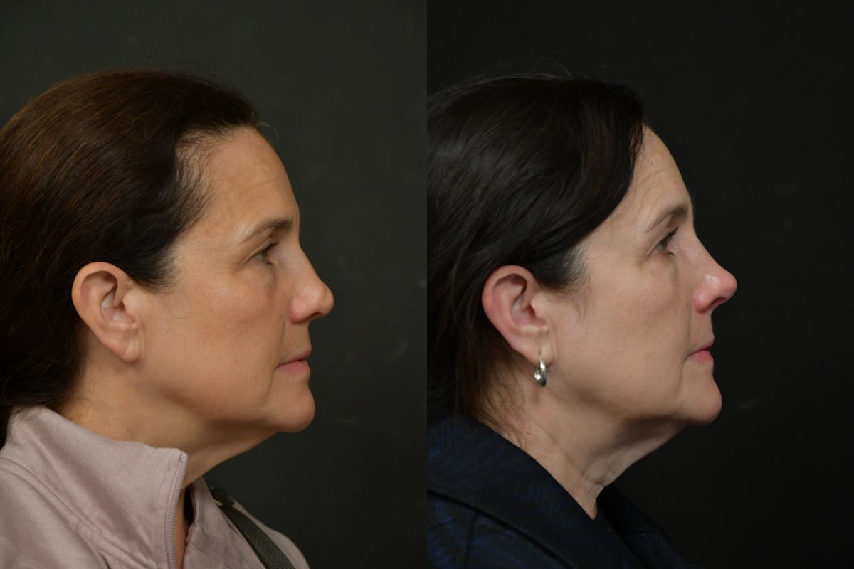 Rhinoplasty Before & After Gallery - Patient 273068 - Image 4