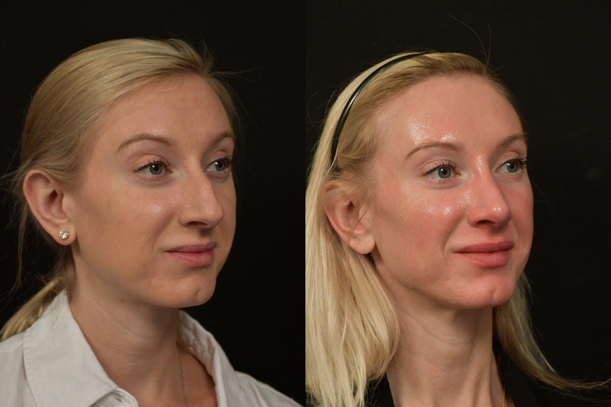 Rhinoplasty Before & After Gallery - Patient 218835 - Image 3