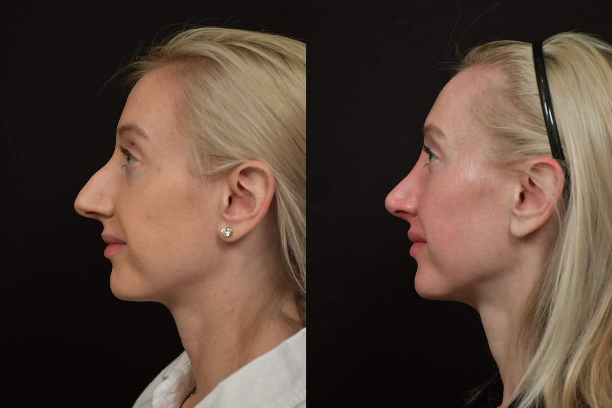Rhinoplasty Before & After Gallery - Patient 218835 - Image 2