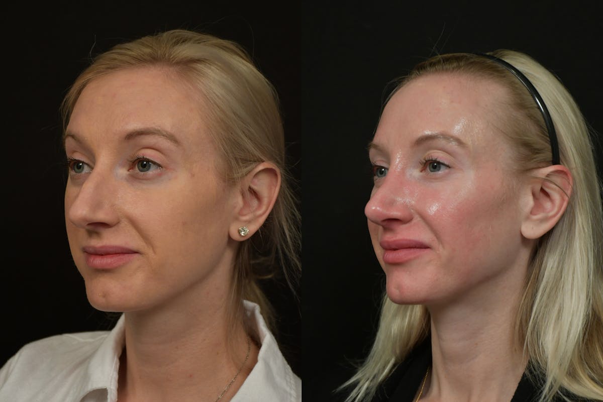 Rhinoplasty Before & After Gallery - Patient 218835 - Image 1