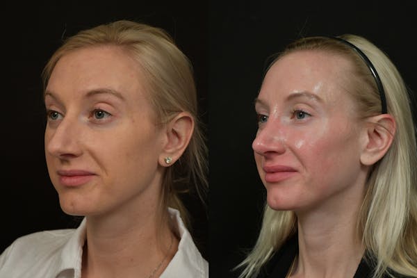 Rhinoplasty Before & After Gallery - Patient 218835 - Image 1