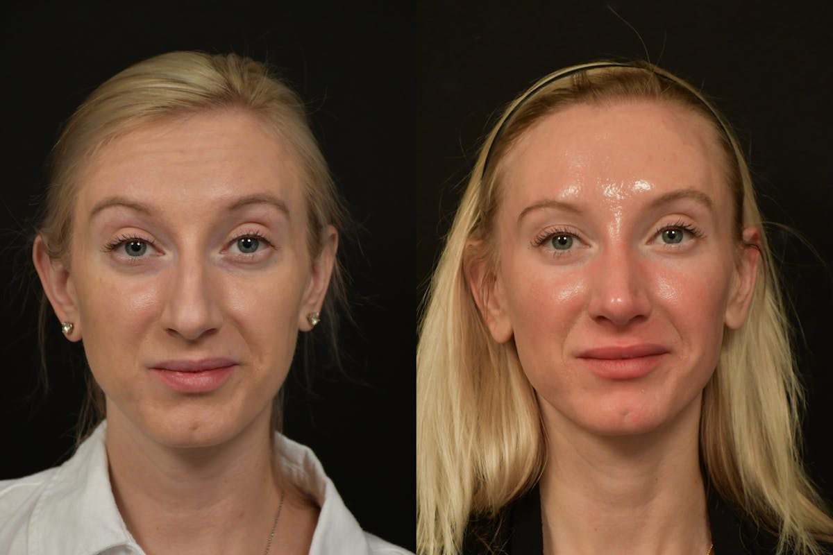 Rhinoplasty Before & After Gallery - Patient 218835 - Image 5