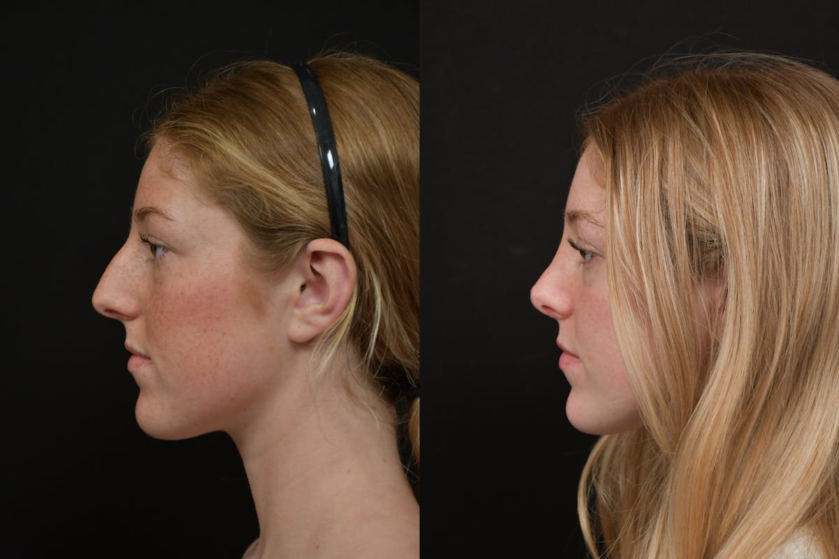 Rhinoplasty Before & After Gallery - Patient 124390 - Image 2