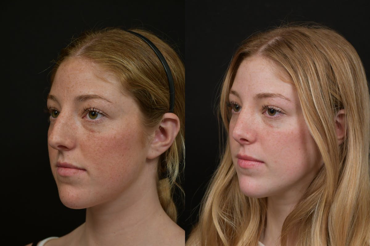 Rhinoplasty Before & After Gallery - Patient 124390 - Image 1