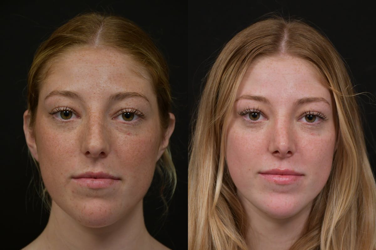 Rhinoplasty Before & After Gallery - Patient 124390 - Image 5