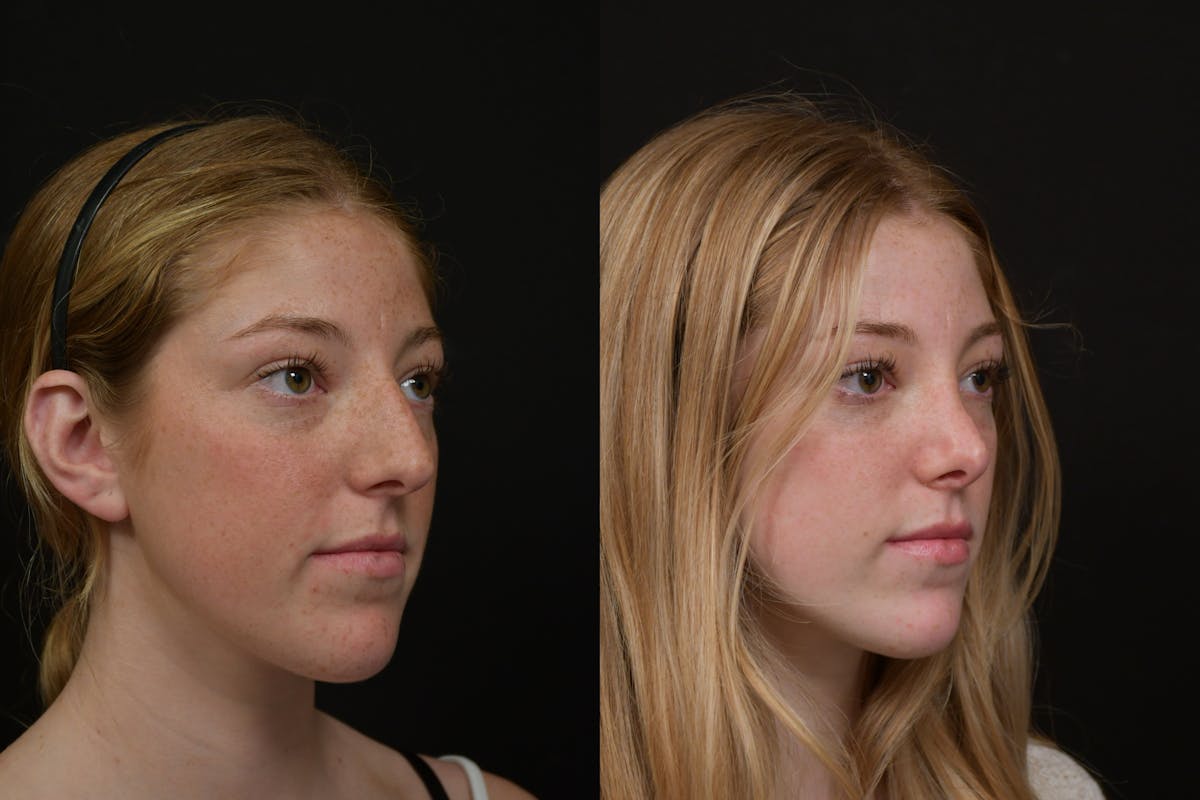Rhinoplasty Before & After Gallery - Patient 124390 - Image 3