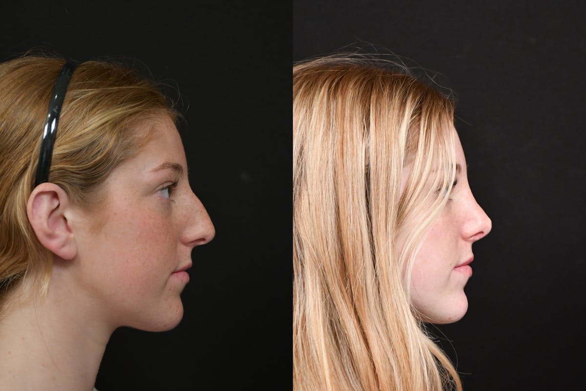 Rhinoplasty Before & After Gallery - Patient 124390 - Image 4