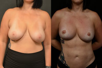 Breast Reduction Before & After Gallery - Patient 147915 - Image 1