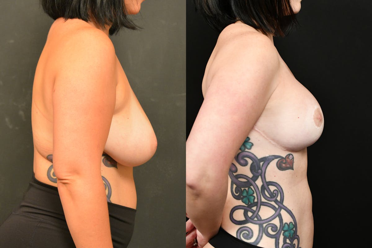 Breast Reduction Before & After Gallery - Patient 147915 - Image 3
