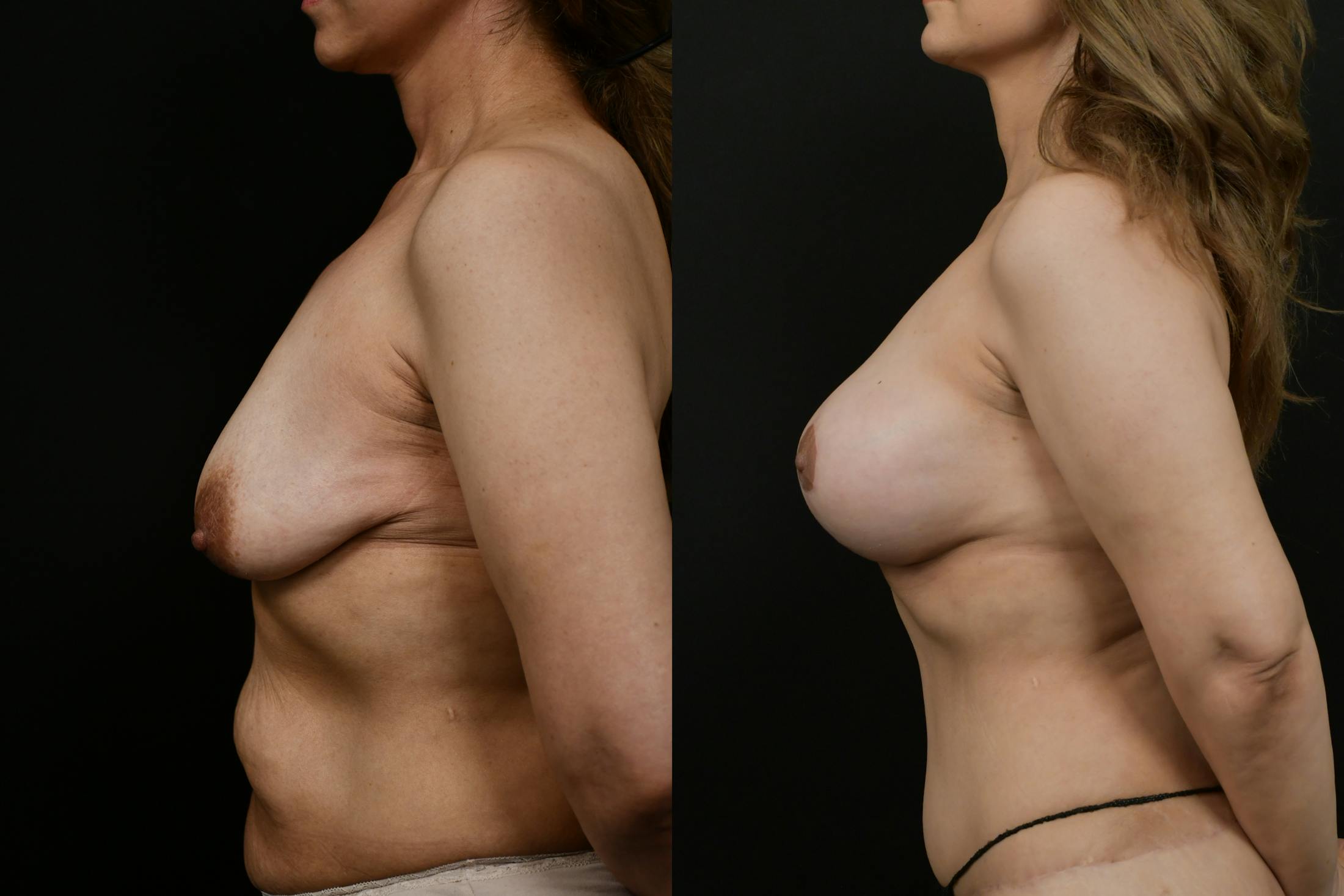 Breast Augmentation Before & After Gallery - Patient 375025 - Image 5