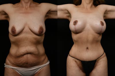 Tummy Tuck Before & After Gallery - Patient 293018 - Image 1