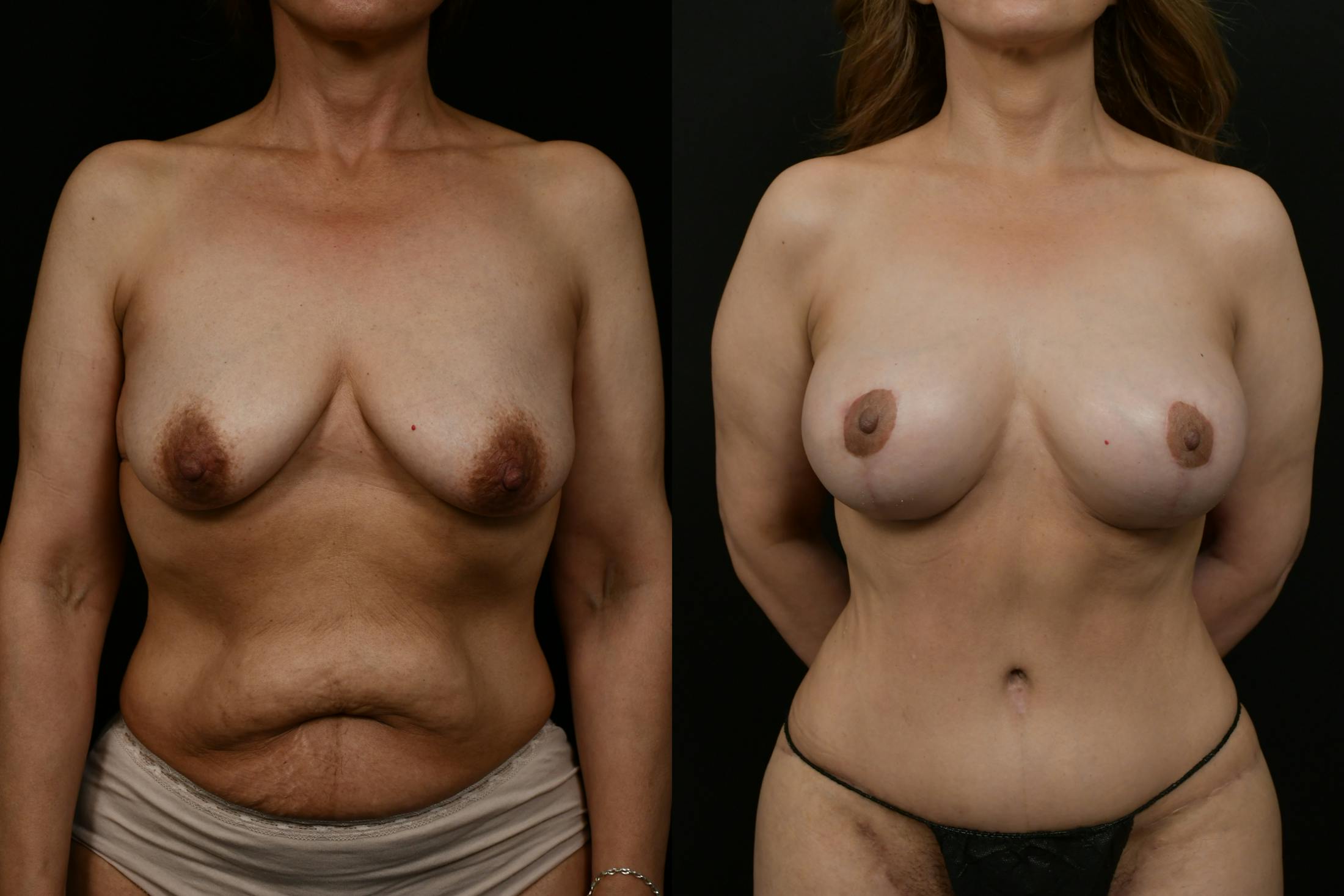 Breast Augmentation Before & After Gallery - Patient 375025 - Image 1