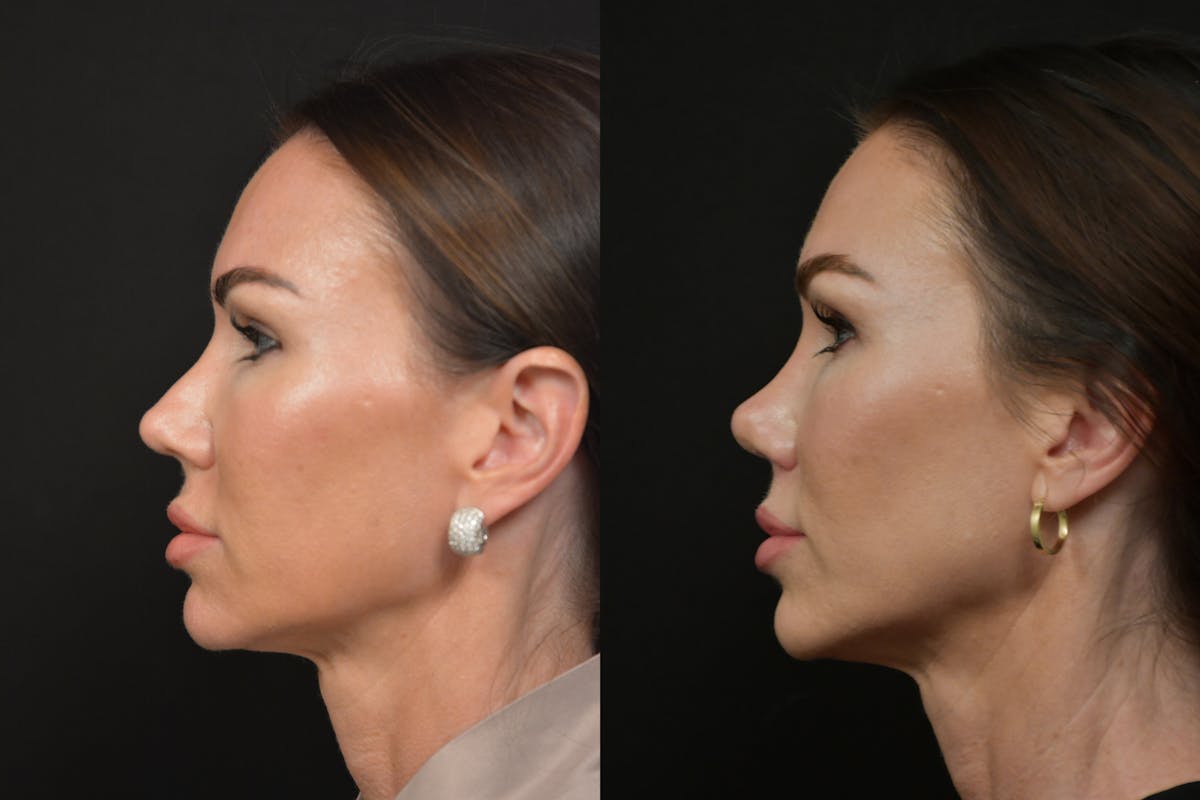 Rhinoplasty Before & After Gallery - Patient 232250 - Image 2