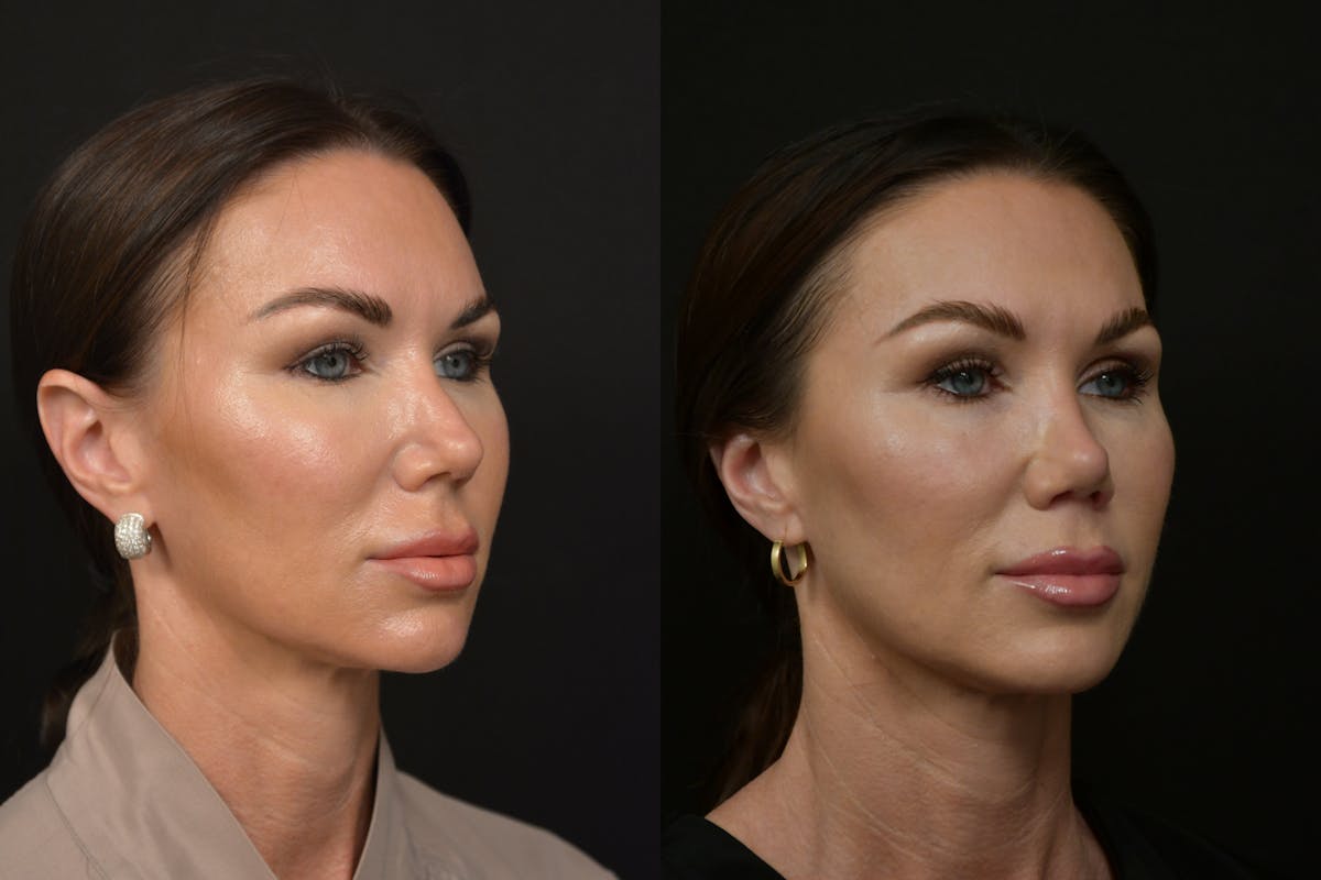 Rhinoplasty Before & After Gallery - Patient 232250 - Image 3