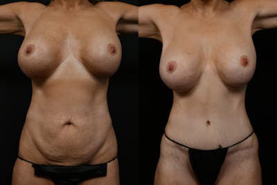 Tummy Tuck Before & After Gallery - Patient 192043 - Image 1