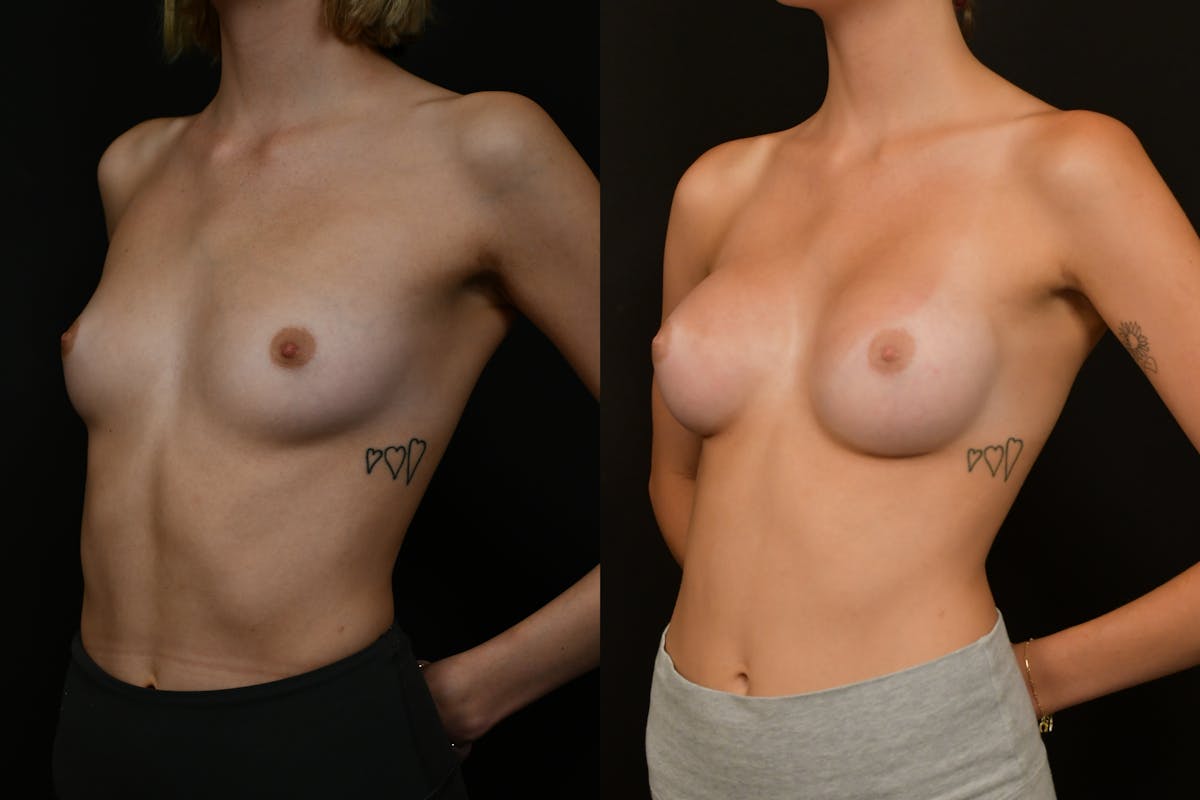 Breast Augmentation Before & After Gallery - Patient 118521 - Image 4
