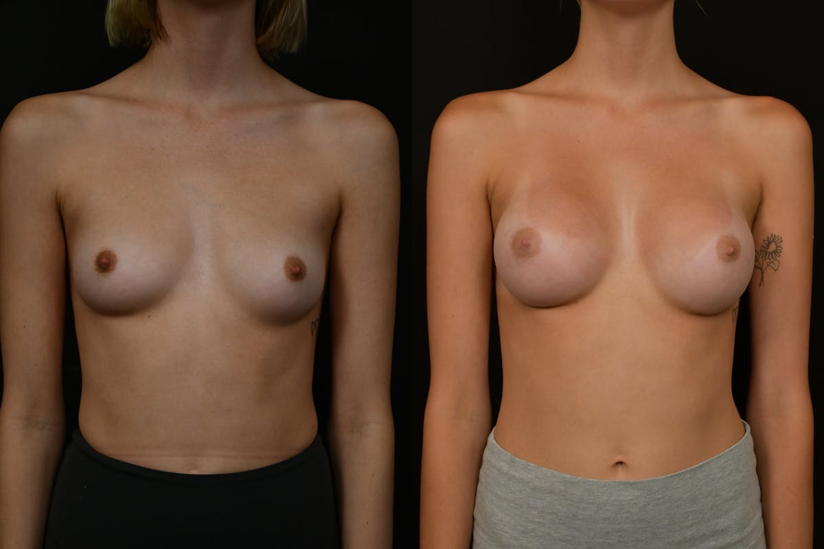 Breast Augmentation Before & After Gallery - Patient 118521 - Image 1