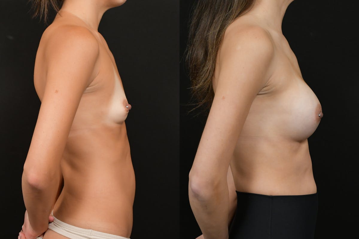 Breast Augmentation Before & After Gallery - Patient 256085 - Image 3