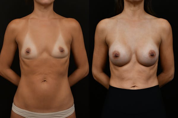 Breast Augmentation Before & After Gallery - Patient 256085 - Image 1