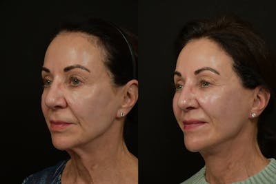 Changes Rapid Lift  Before & After Gallery - Patient 379979 - Image 1