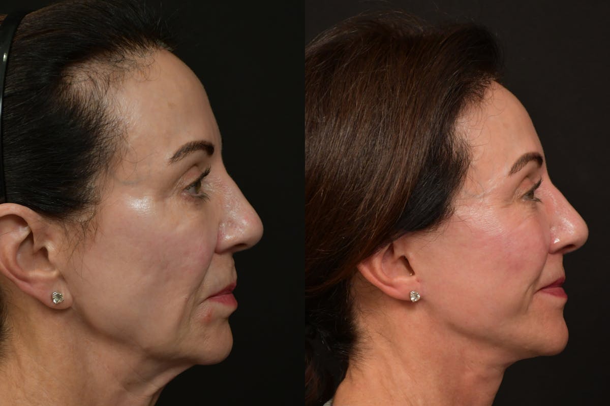 Changes Rapid Lift  Before & After Gallery - Patient 379979 - Image 4